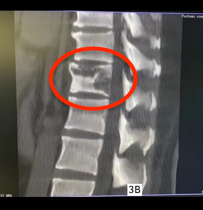 挑战生命禁区——脊柱外科独立完成桂医附院首例脊柱肿瘤全切术