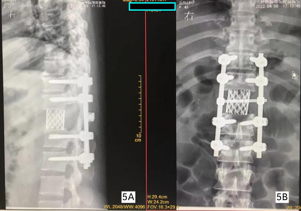 挑战生命禁区——脊柱外科独立完成桂医附院首例脊柱肿瘤全切术