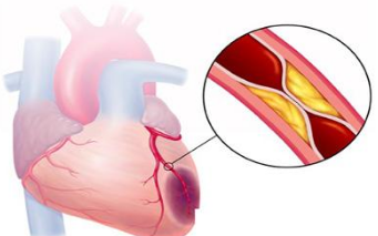 什么是心肌梗死？