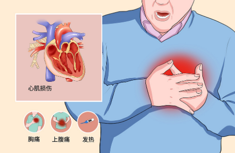 什么是心肌梗死？