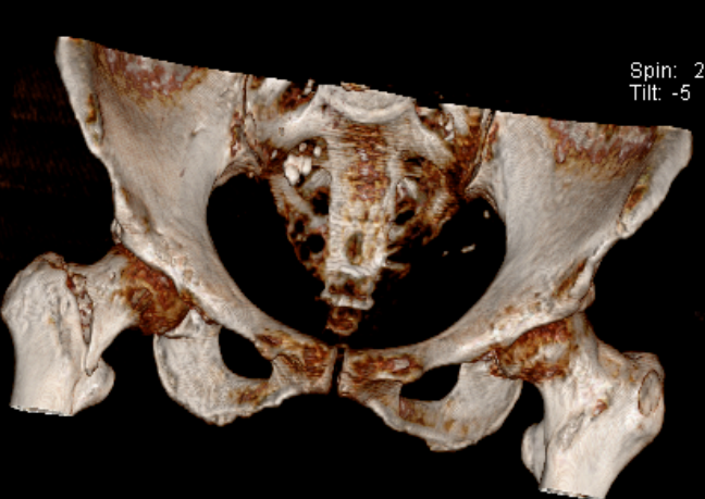 2 名「90 后」高龄老人遇凶险骨折?莫慌!速手术!