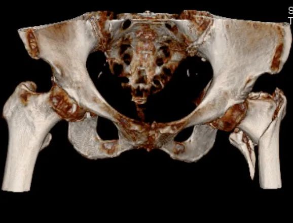 2 名「90 后」高龄老人遇凶险骨折?莫慌!速手术!