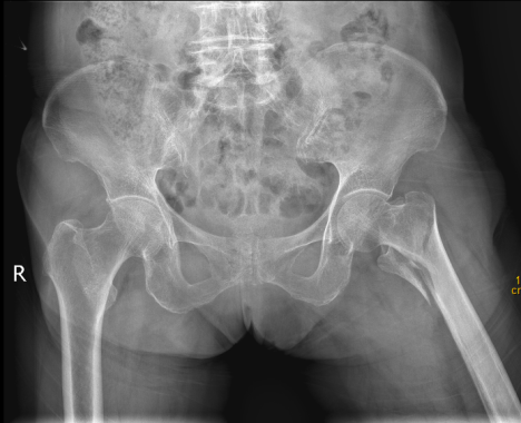 2 名「90 后」高龄老人遇凶险骨折?莫慌!速手术!