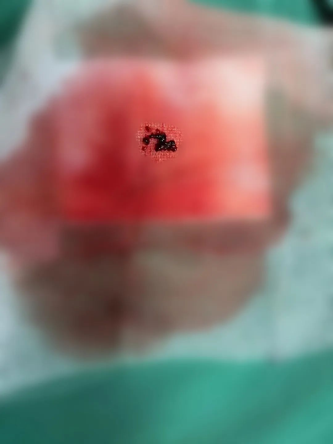 走近 MDT 团队：脑梗死救治团队两大技术轮番上阵，为脑梗患者保驾护航