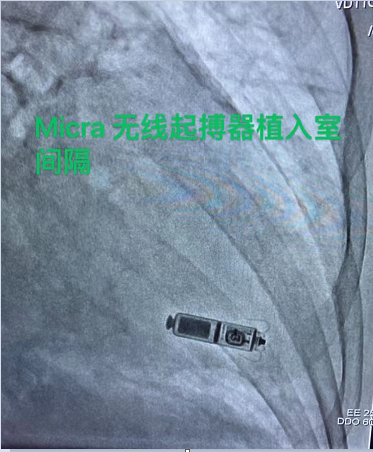 广西壮族自治区南溪山医院成功完成首例 Micra 无导线起搏器植入术