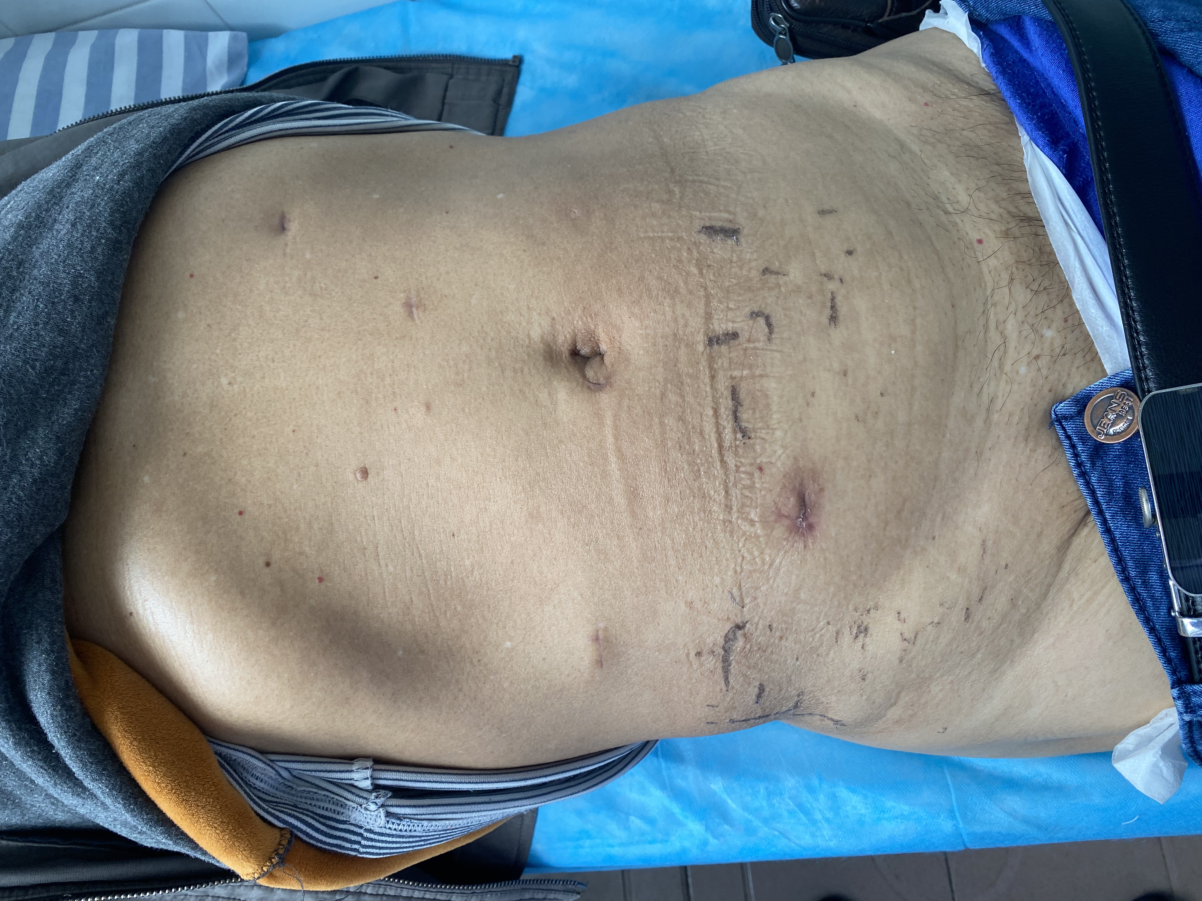 广西壮族自治区南溪山医院机器人直肠癌根治手术实现「无痕」