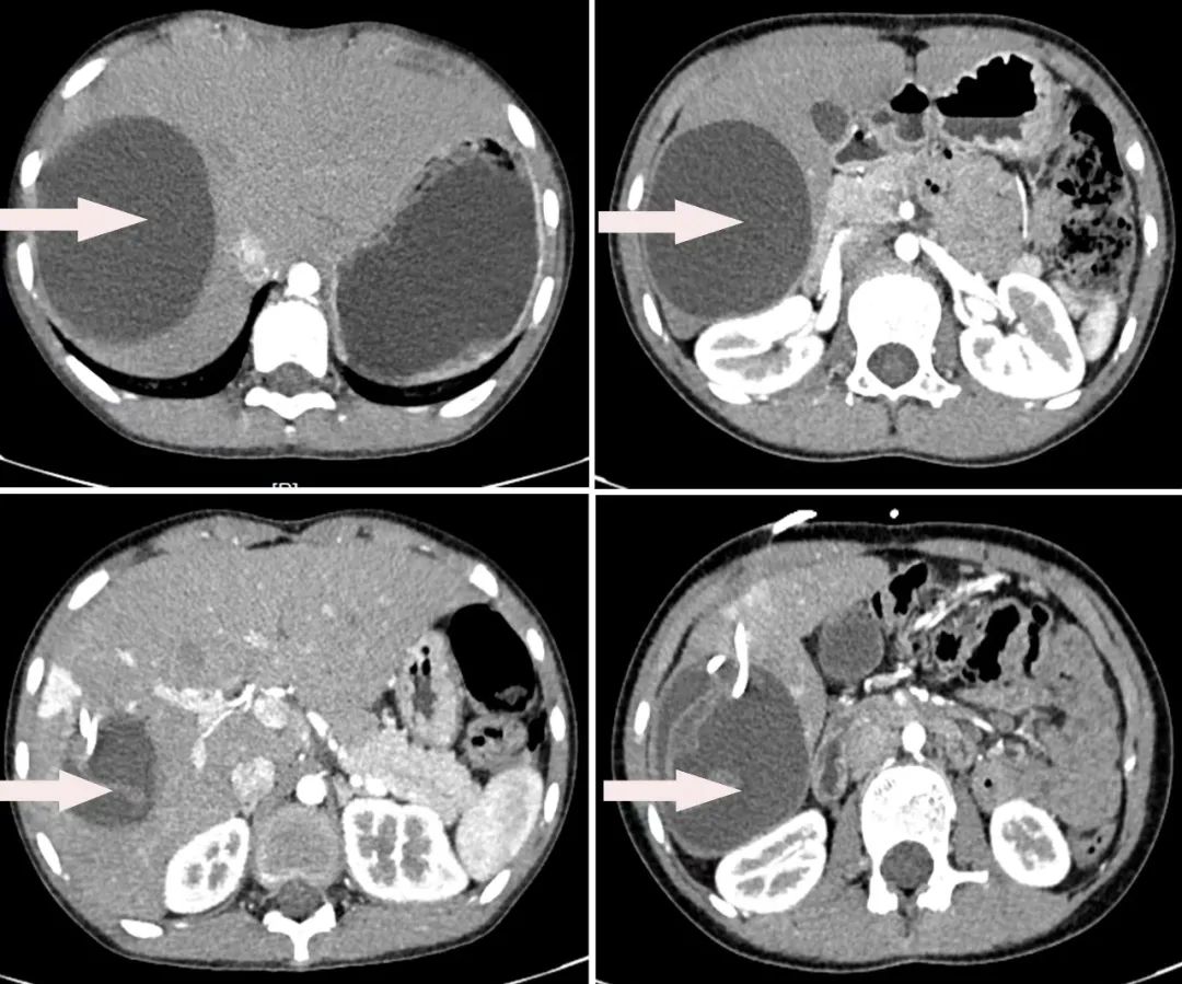 歲女性,因「腹部脹痛不適半月」入院,經 ct 檢查提示肝左葉巨大佔位性