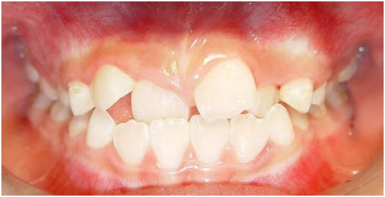 牙齿不齐竟会遗传!别坐等孩子牙齿越长越歪,三岁就可以开始矫正了
