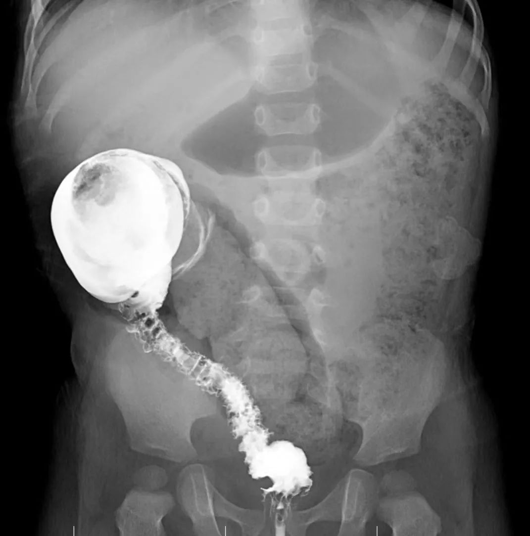 孩子排便少,家长要警惕!