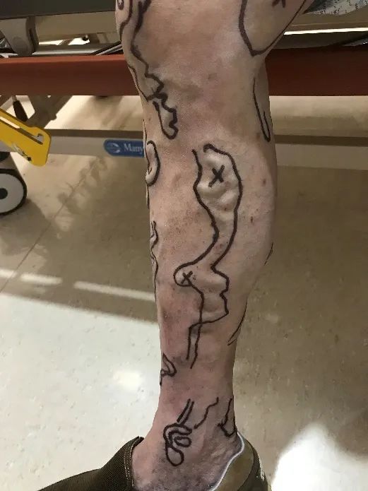 聊一聊腿上那些莫名其妙的「小蚯蚓」