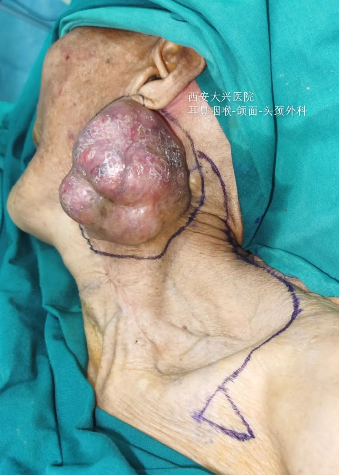 设计精巧!小马哥踢开「绊脚石」,完美切除 87 岁老太拳头大肿瘤