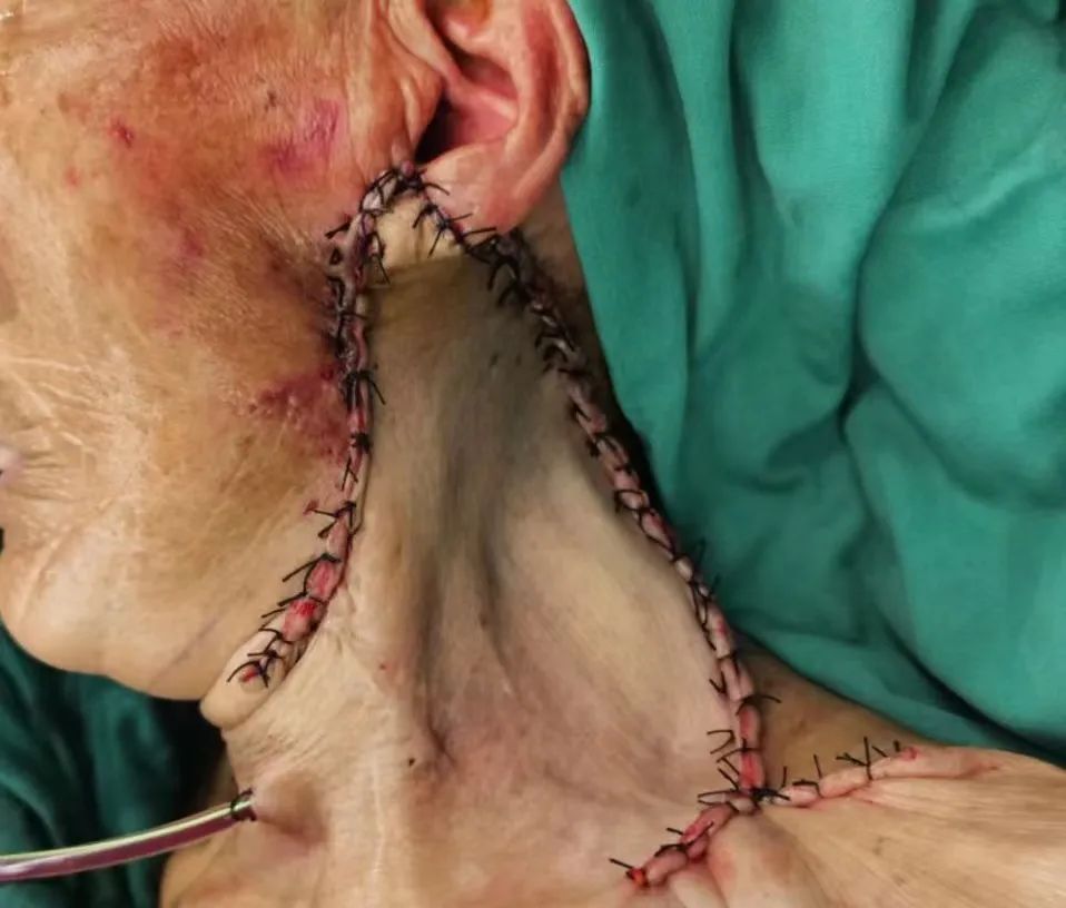 设计精巧!小马哥踢开「绊脚石」,完美切除 87 岁老太拳头大肿瘤