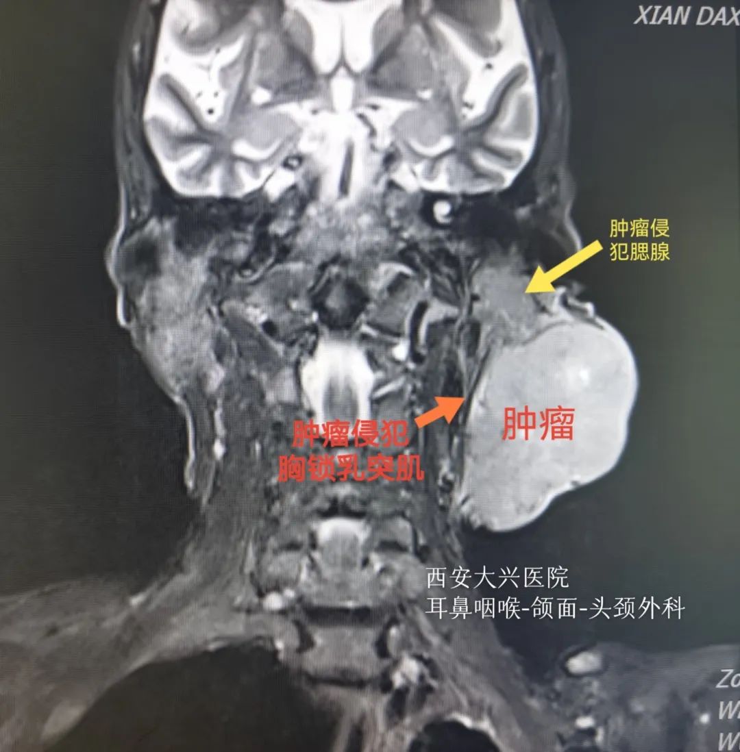 设计精巧!小马哥踢开「绊脚石」,完美切除 87 岁老太拳头大肿瘤