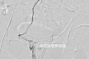 有「痔」之士的福音：痔疮也可以介入治疗