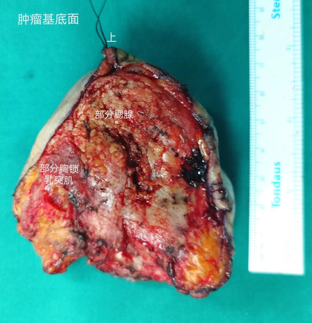 设计精巧!小马哥踢开「绊脚石」,完美切除 87 岁老太拳头大肿瘤