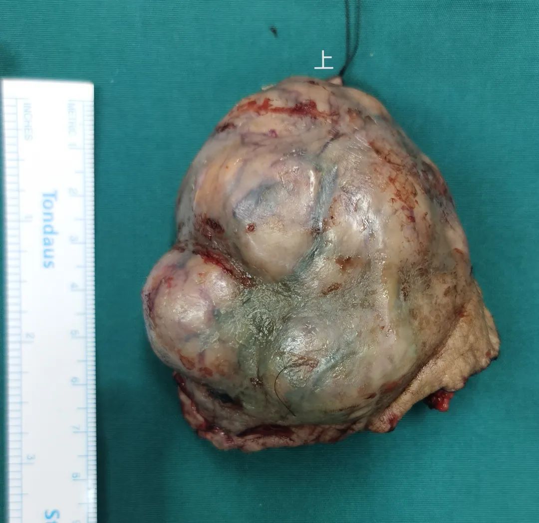 设计精巧!小马哥踢开「绊脚石」,完美切除 87 岁老太拳头大肿瘤