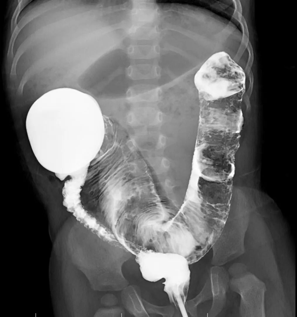 孩子排便少,家长要警惕!