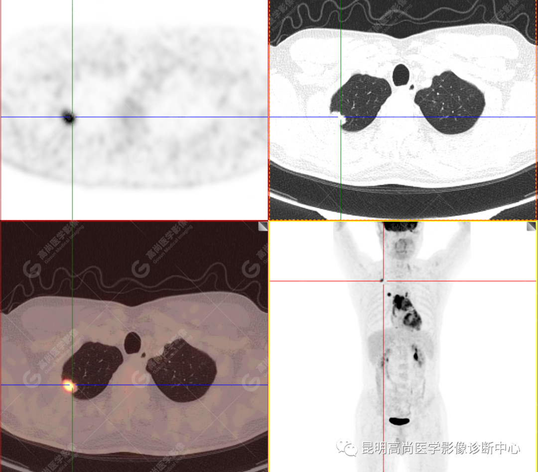 高尚病例：胸腺癌一例