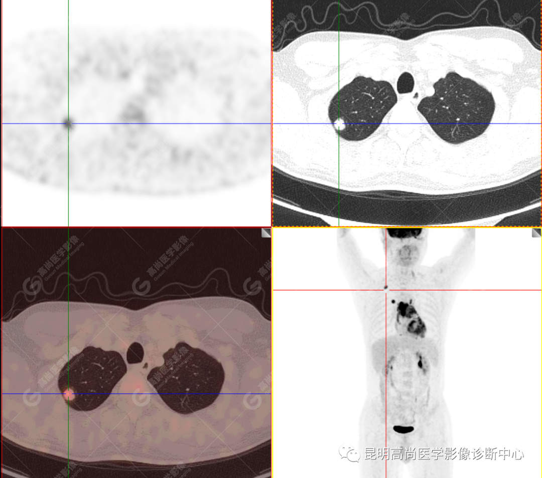 高尚病例：胸腺癌一例