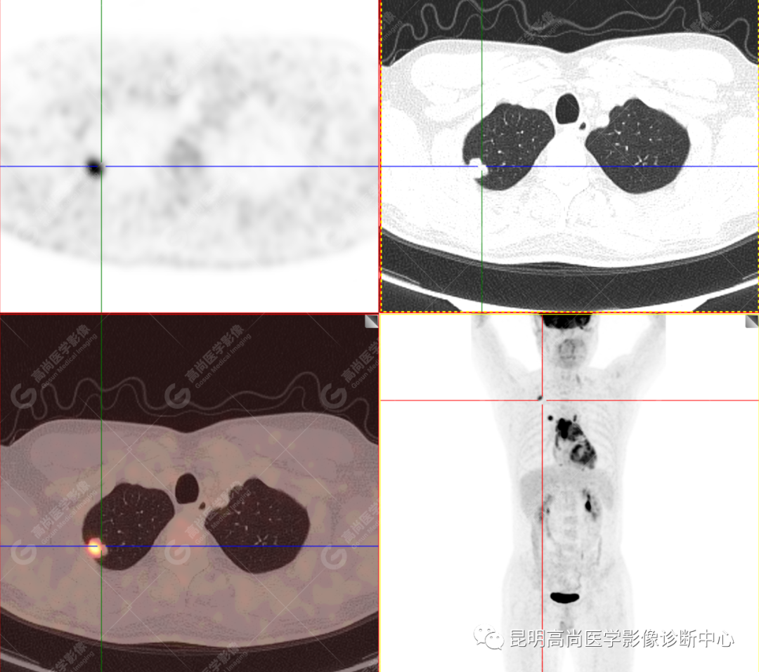 高尚病例：胸腺癌一例