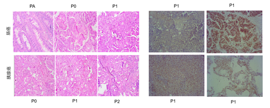 浅谈乳腺癌与 PDX 药筛