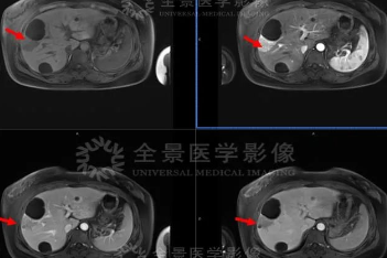 检查发现肝脏肿瘤，一定就是肝癌吗？