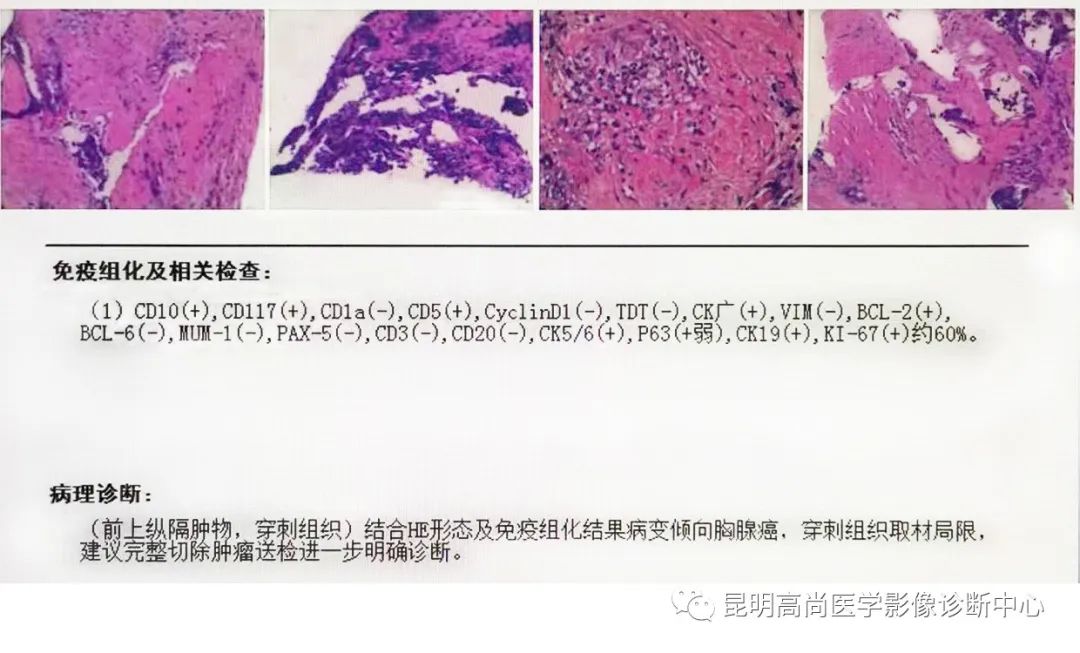 高尚病例：胸腺癌一例