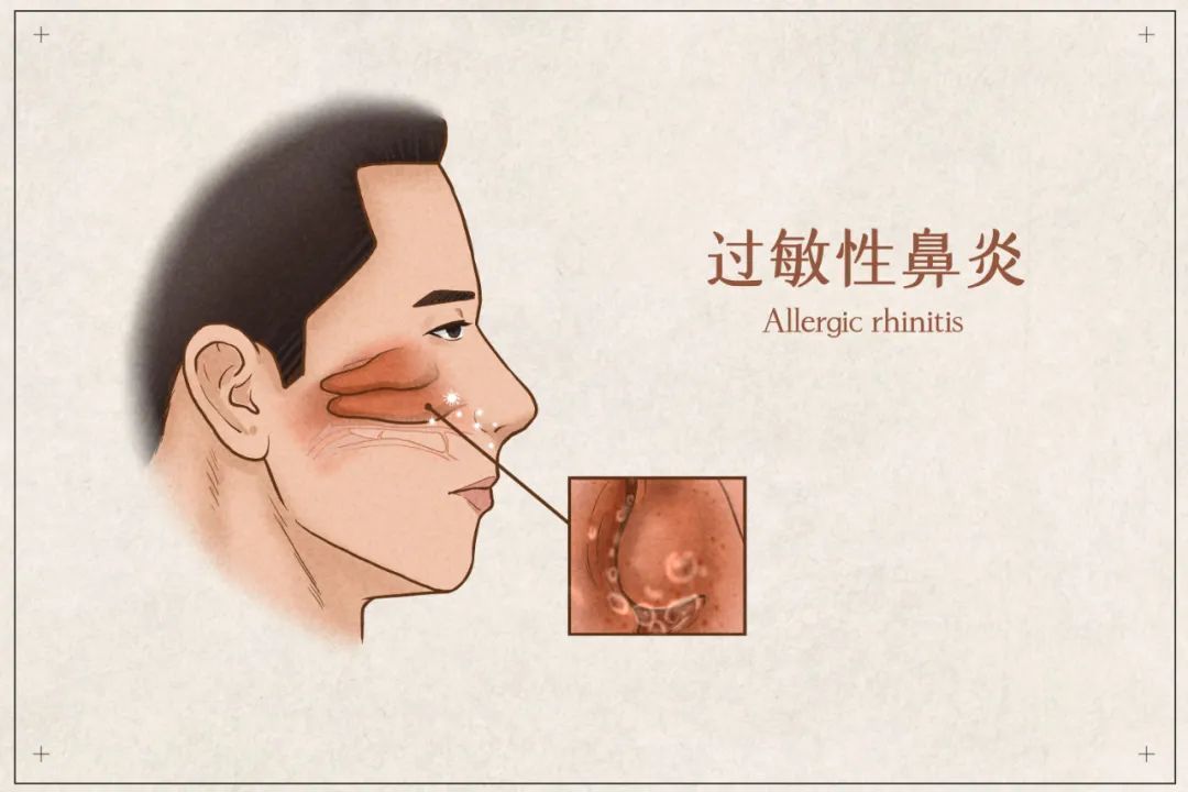 春天遇上疫情季，除了预防新冠和感冒，还要注意这个！