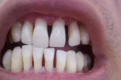 不想年纪轻轻就「老掉牙」？深圳市罗湖人民医院口腔科提醒：及时就医可保住牙齿