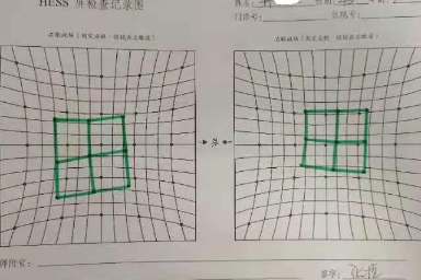 7 旬老人看东西重影不敢走路，这是怎么回事？