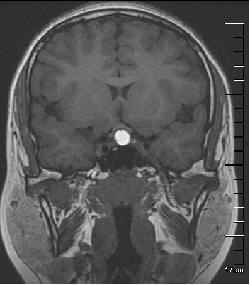 高尚病例:易误诊为垂体瘤的 Rathke 囊肿