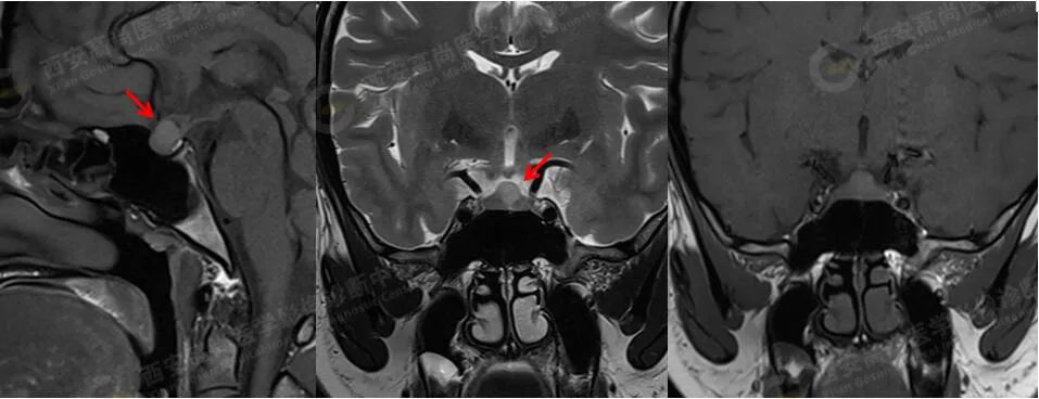 高尚病例:易误诊为垂体瘤的 Rathke 囊肿