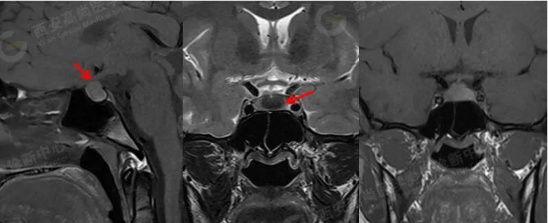 高尚病例:易误诊为垂体瘤的 Rathke 囊肿