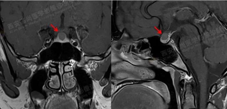高尚病例:易误诊为垂体瘤的 Rathke 囊肿