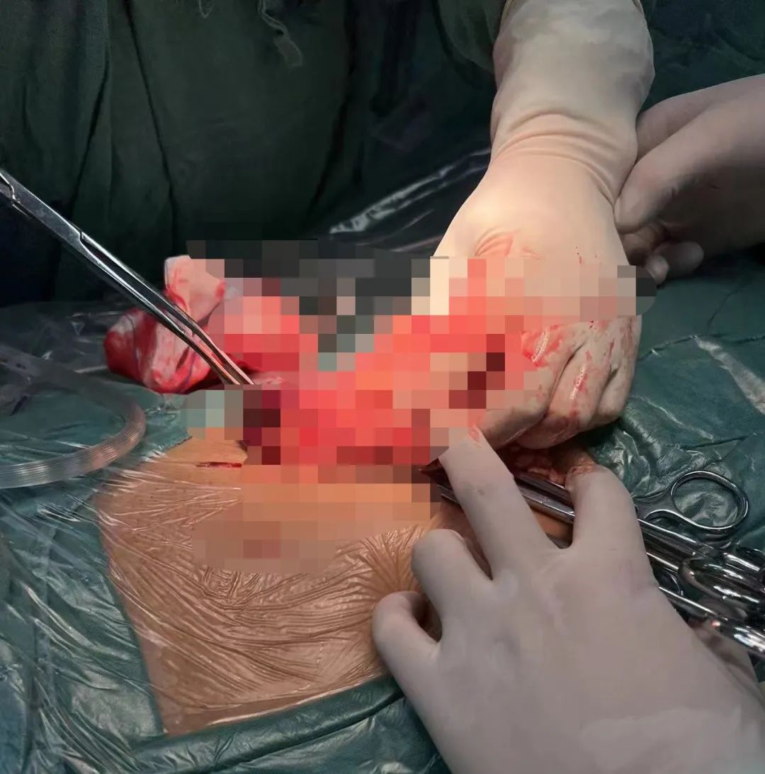 30 年前手术刀口有鼓包，拖延 10 年「板栗」变「馒头」