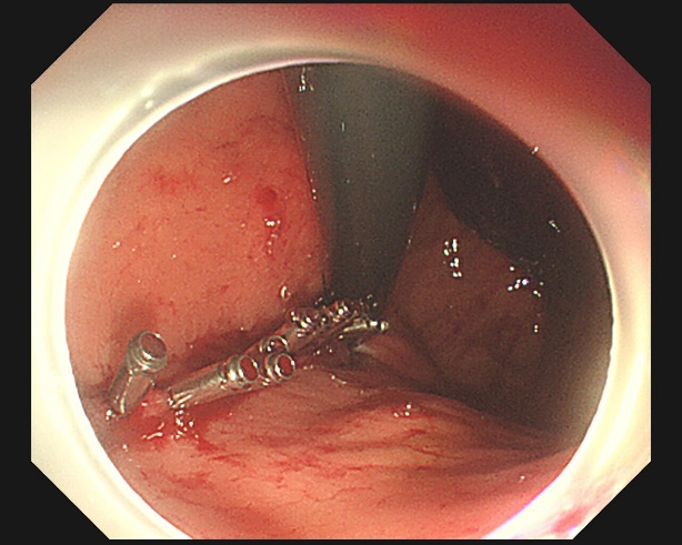 一口气炫一瓶扎啤后,他吐血 1000 毫升!永远不要为了强凹人设而搭进去命