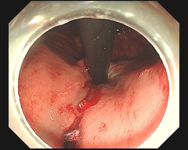 一口气炫一瓶扎啤后,他吐血 1000 毫升!永远不要为了强凹人设而搭进去命