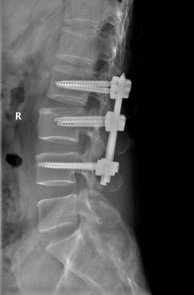 高空坠伤多处骨折  微创手术成功「接骨」