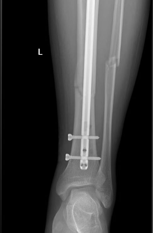 高空坠伤多处骨折  微创手术成功「接骨」