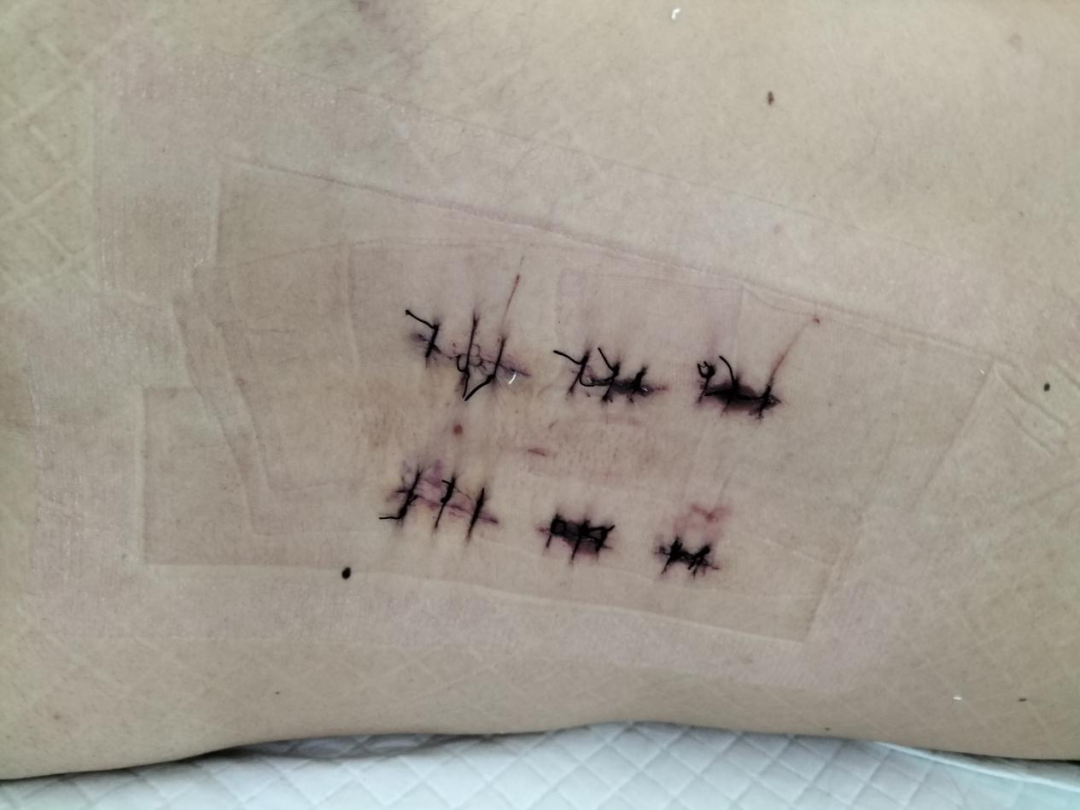 高空坠伤多处骨折  微创手术成功「接骨」