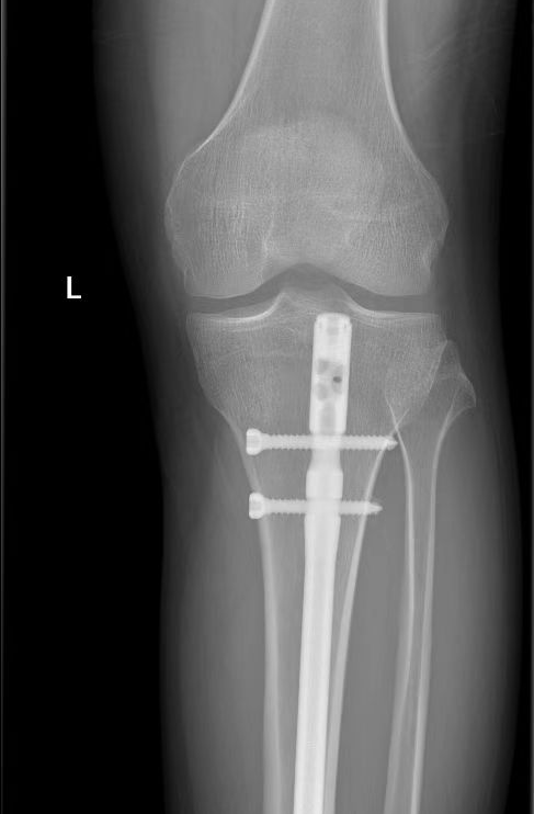 高空坠伤多处骨折  微创手术成功「接骨」