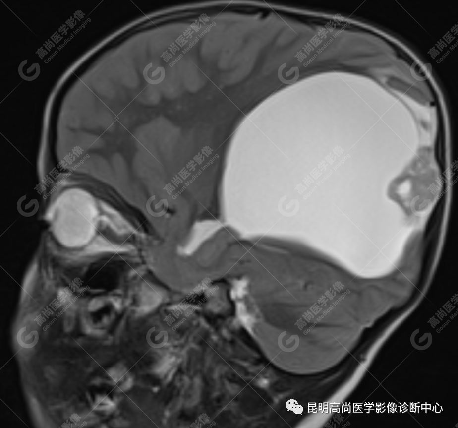 高尚病例：侧脑室三角区室管膜瘤一例