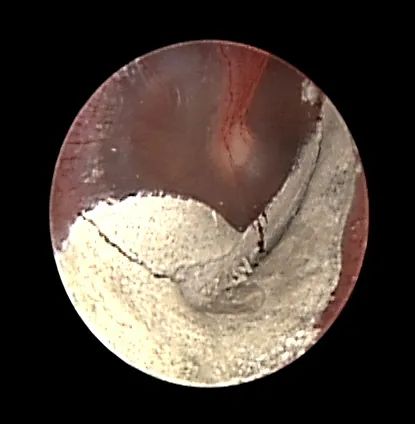 水泥堵耳！京医专家巧手解顽疾