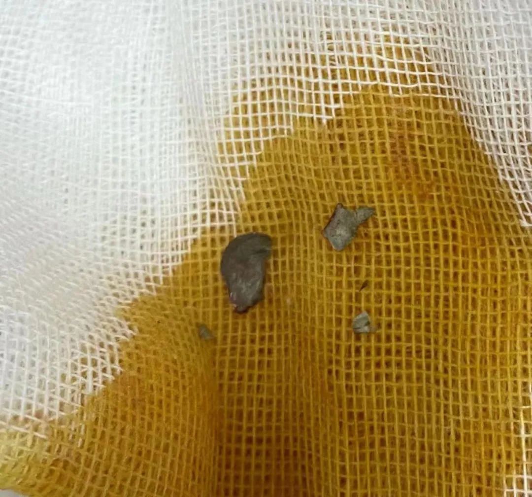 水泥堵耳！京医专家巧手解顽疾