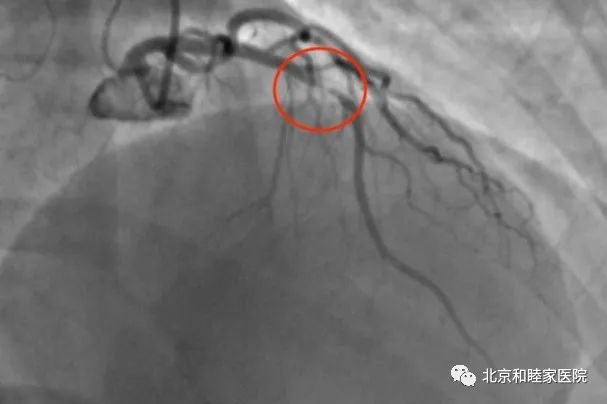 年轻女性也会突发心梗?警惕这 6 大危险因素