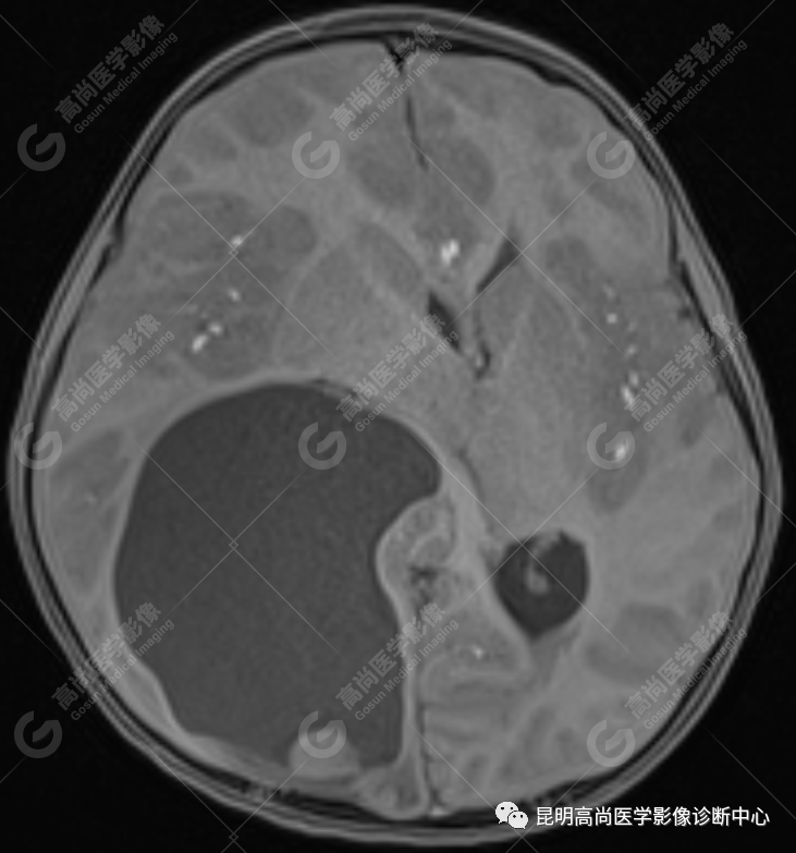 高尚病例：侧脑室三角区室管膜瘤一例