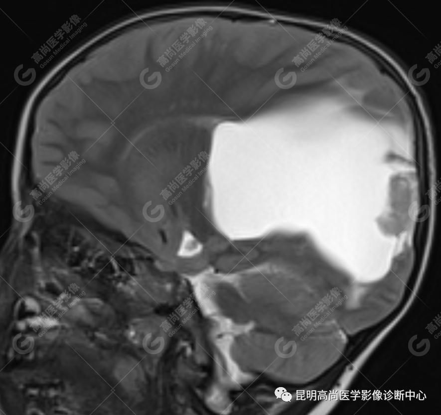 高尚病例：侧脑室三角区室管膜瘤一例