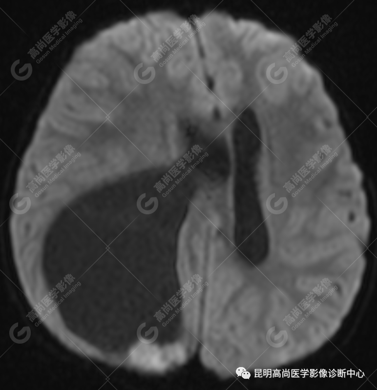 高尚病例：侧脑室三角区室管膜瘤一例