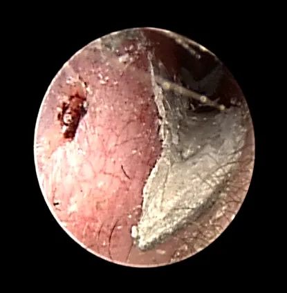 水泥堵耳！京医专家巧手解顽疾