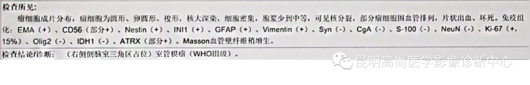 高尚病例：侧脑室三角区室管膜瘤一例